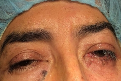 Eyelid