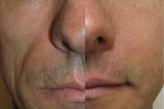 Fillers