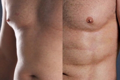 Lipo